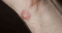 6 home remedies to get rid of a ringworm infection