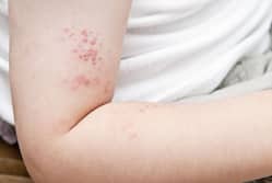 5 home remedies for shingles or herpes zoster virus