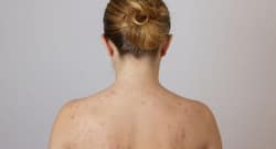 6 things you shouldn’t do to your skin when suffering from folliculitis