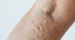 Swelling +4 symptoms of varicose veins you should know