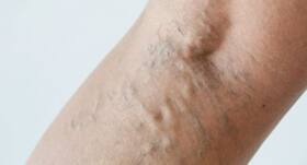 Swelling +4 symptoms of varicose veins you should know Swelling +4 symptoms of varicose veins you should know