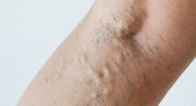 Swelling +4 symptoms of varicose veins you should know