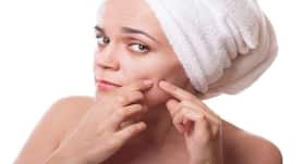 5 home remedies for whiteheads that actually work!