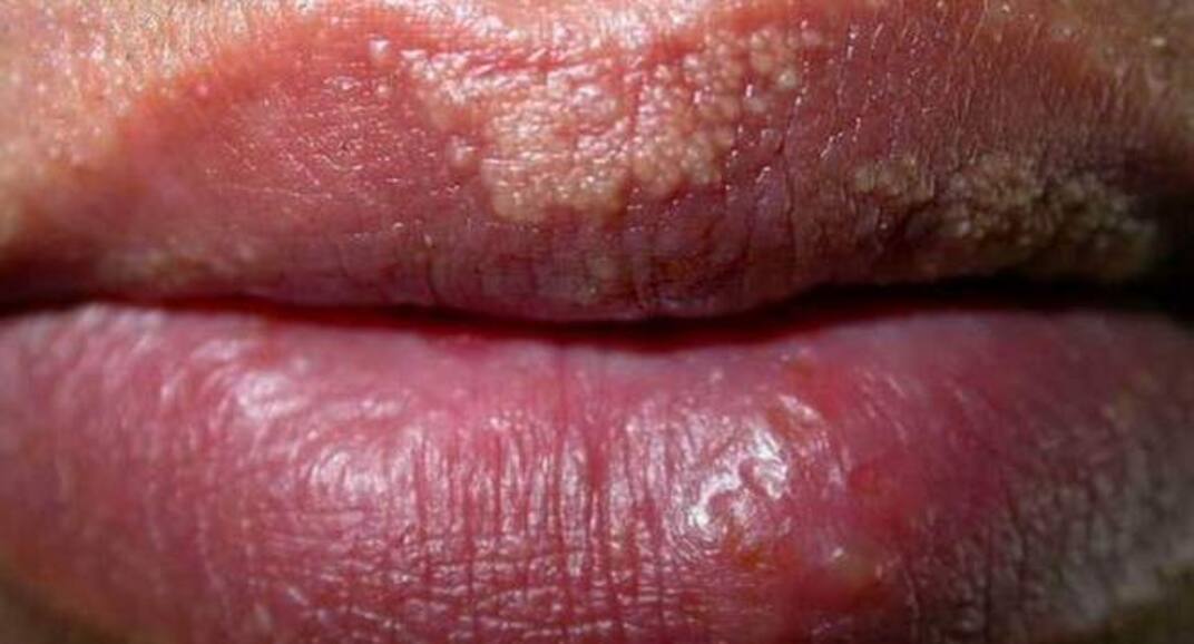 6 things your lips say about your health