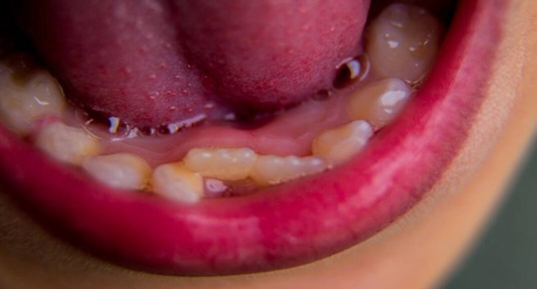 6 things your lips say about your health