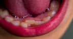 7 Benefits Of Fixed Implant Supported Teeth Over Removable Dentures