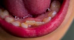 7 Benefits Of Fixed Implant Supported Teeth Over Removable Dentures