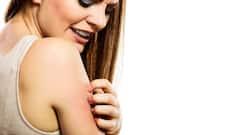 4 shocking ways living with eczema could affect your health