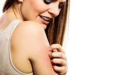 4 shocking ways living with eczema could affect your health
