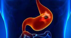 5 expert tips to prevent stomach ulcers