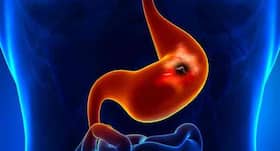 5 expert tips to prevent stomach ulcers 5 expert tips to prevent stomach ulcers