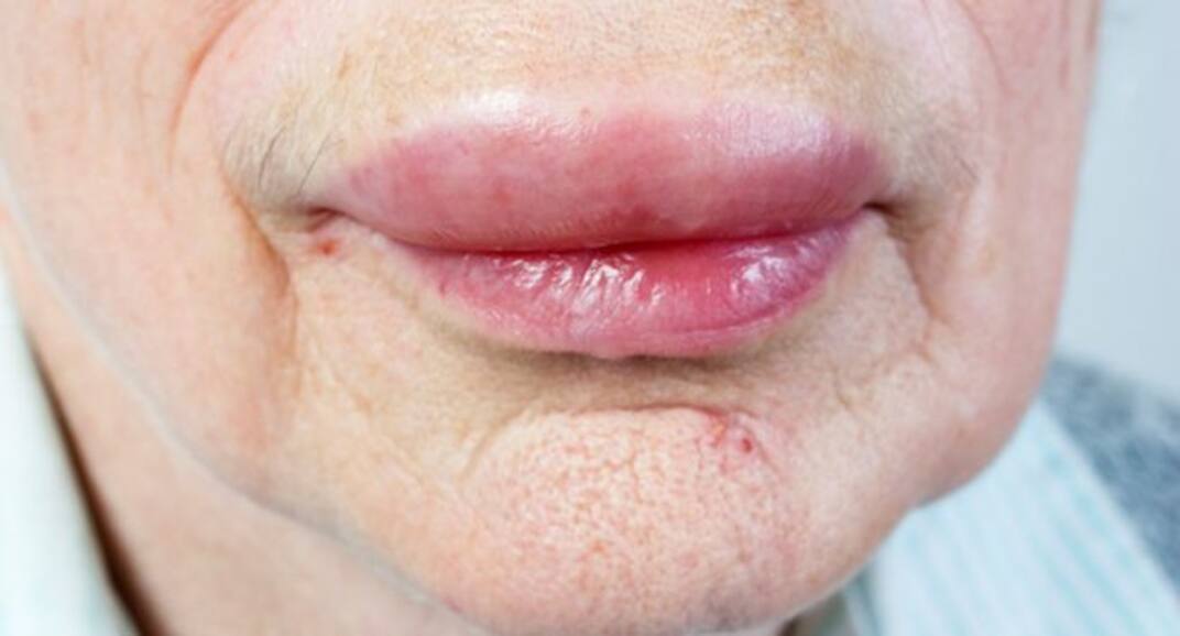 6 things your lips say about your health