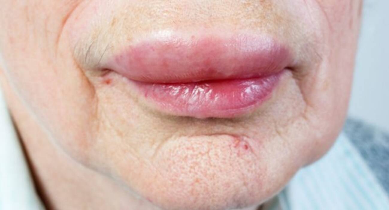 Heart Problem Lips 6 things your lips say about your health | TheHealthSite.com Photo Gallery