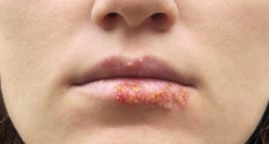 8 highly contagious skin diseases that you should be aware of ...
