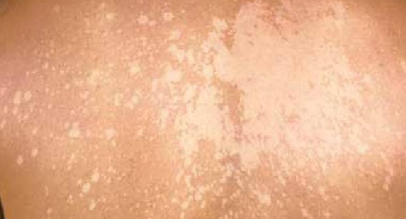 Diffuse White Rash 10 reasons of white patches or spots on your skin | TheHealthSite.com ...