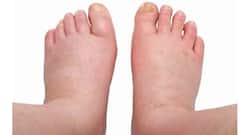 5 causes of water retention and expert tips to prevent it