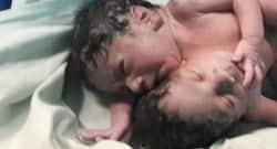 Odisha government to bear medical expenses of newborn conjoined twins again
