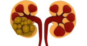8 facts about kidney stones you need to know