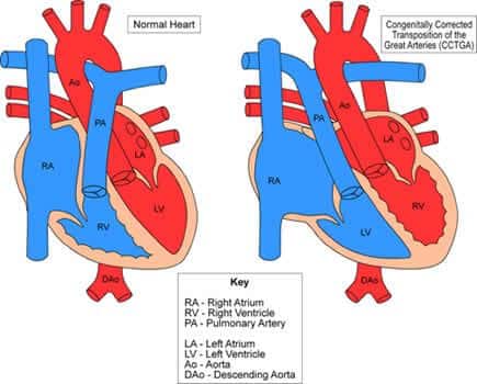 Normal vs CGTA Heart