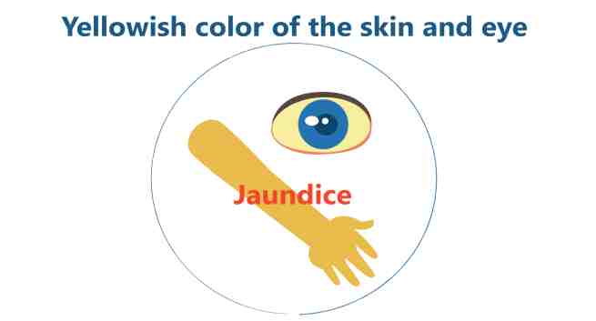 Yellowing Of The Eyes: Understanding Jaundice And Its Impact On Eye Health - Vimarsana News