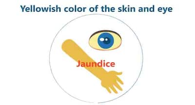 Yellowing Of The Eyes: Understanding Jaundice And Its Impact On Eye Health