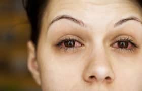 15 common causes of red or bloodshot eyes you need to know