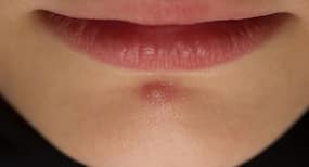 Chin पर pimples होने से कैसे रोकूं?