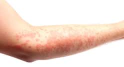 5 reasons you could be breaking out in hives