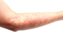 5 reasons you could be breaking out in hives