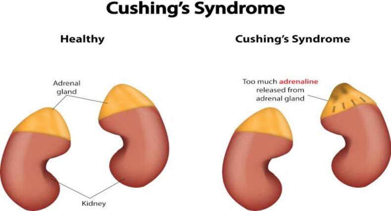 6 possible causes of sudden weight gain that need attention right now