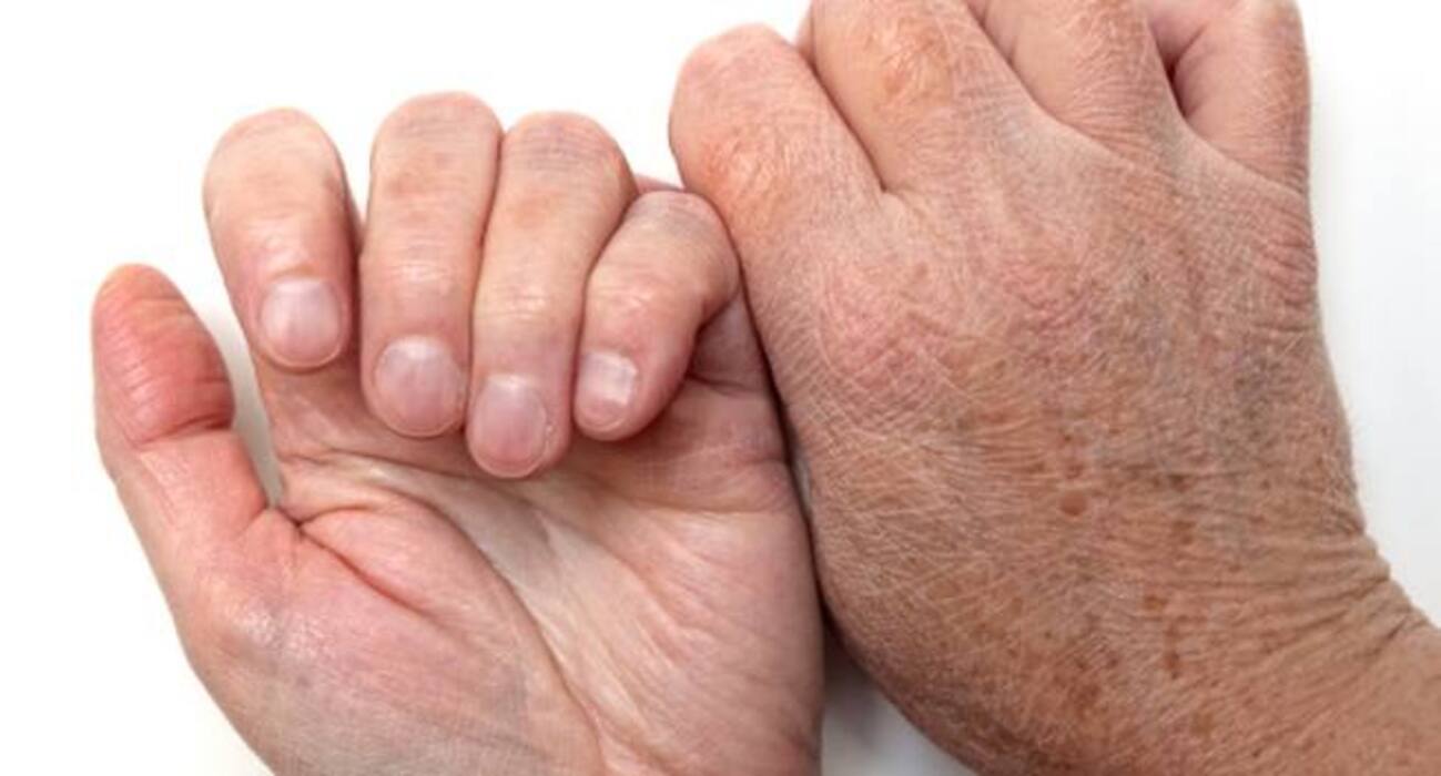 स्ट्रेस से हो सकती हैं ये 6 स्किन प्रॉब्लम्स