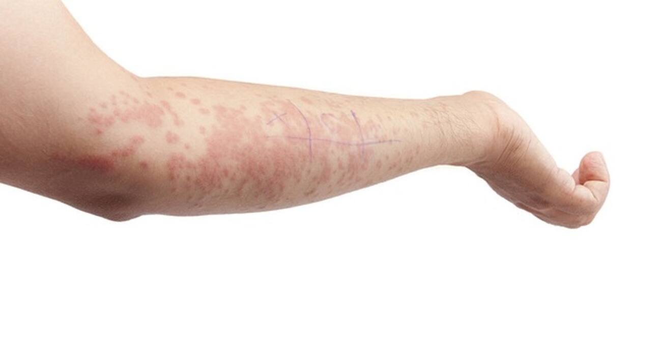 स्ट्रेस से हो सकती हैं ये 6 स्किन प्रॉब्लम्स