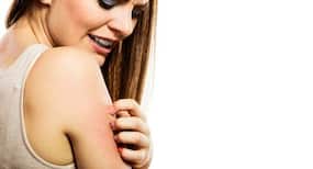 6 foods you SHOULD NOT eat if you suffer from eczema