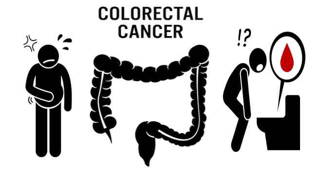 5 signs and symptoms of colorectal cancer - Read Health Related Blogs ...