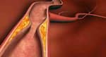 Coronary artery disease
