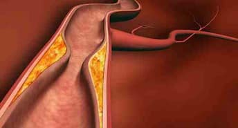 Coronary artery disease