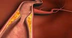 Arteriosclerosis