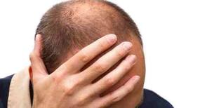 6 rules to follow after a hair transplant