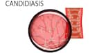 Candidiasis