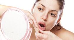 How can I prevent acne on chin? (Beauty query)