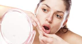 How can I prevent acne on chin? (Beauty query)