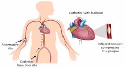 Angiography – 7 things you need to know