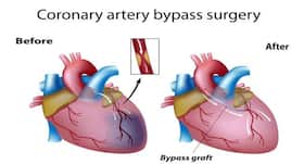 6 myths of bypass surgery busted! 6 myths of bypass surgery busted!
