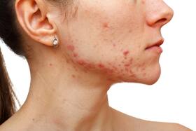 4 mental illnesses that could cause acne