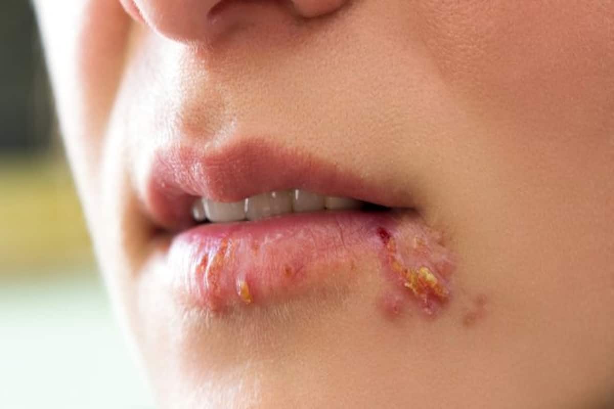 Of get herpes bumps rid ways to 10 Ways