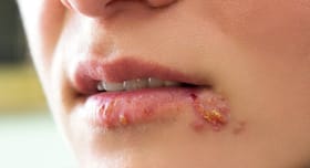 This is how you can get rid of a cold sore This is how you can get rid of a cold sore