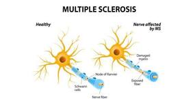 Brain disease: novel nuclear medicine technique can combat Parkinson's disease, Alzheimer's and multiple sclerosis