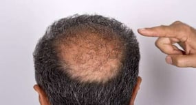 Severe hair loss could be a sign of Vitamin D deficiency Severe hair loss could be a sign of Vitamin D deficiency