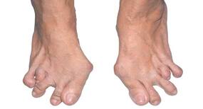 How rheumatoid arthritis affects the foot and ankle