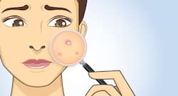4 reasons you have random acne and skin breakouts